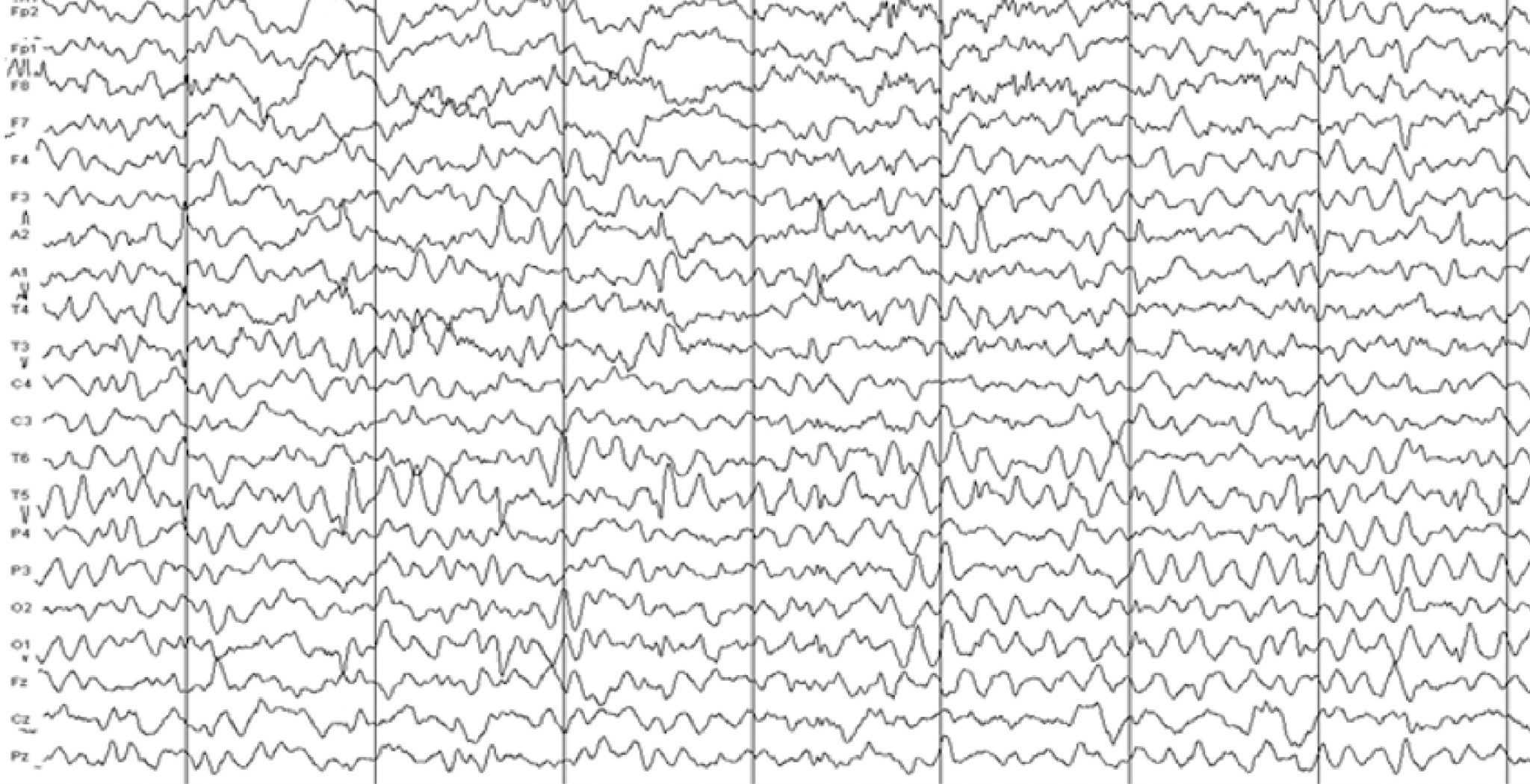 EEG with delirium